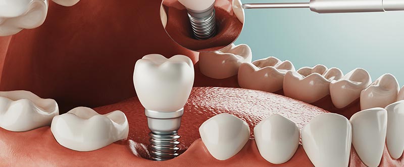Dental Implants Near Me in Oxnard, CA