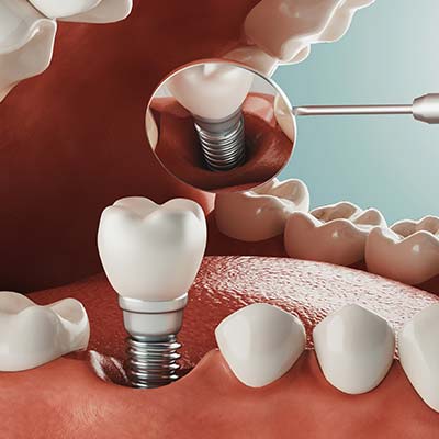 Dental Implants Near Me in Oxnard, CA